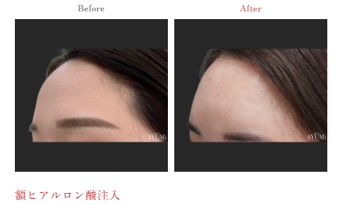 案例1：自体血清活性化疗法改善甲状腺肿瘤